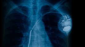 Pacemaker cell x-ray image