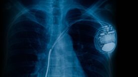 Pacemaker cell x-ray image